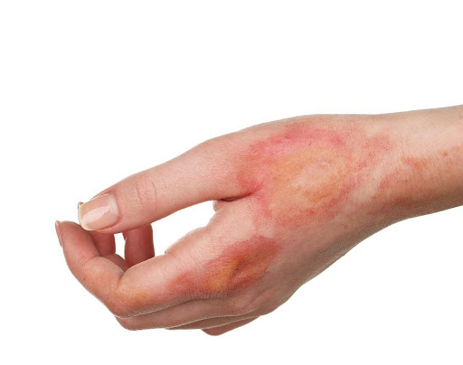 burned hand image